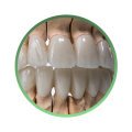 Металлокерамика, коронки и мосты для протезирования зубов
